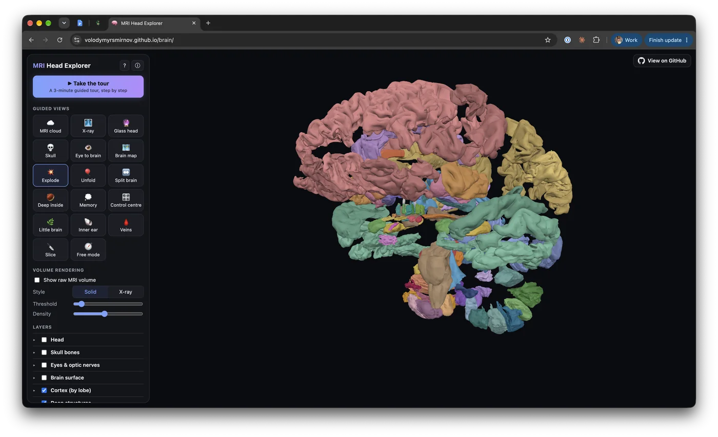 MRI Head Explorer in the browser: my brain in the Explode view, with the guided views and layers on the left